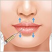 脂肪注入で唇をふっくら厚く