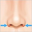 鼻翼縮小(小鼻縮小)