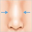 鼻の骨切り幅寄せ