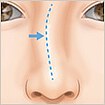 斜鼻修正(曲がった鼻をまっすぐに)