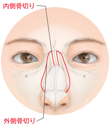 曲がった鼻を美しく整える手術・斜鼻修正：美容外科 高須クリニック