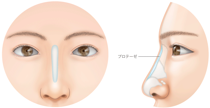 鼻根部から鼻背にかけてプロテーゼを入れる場合