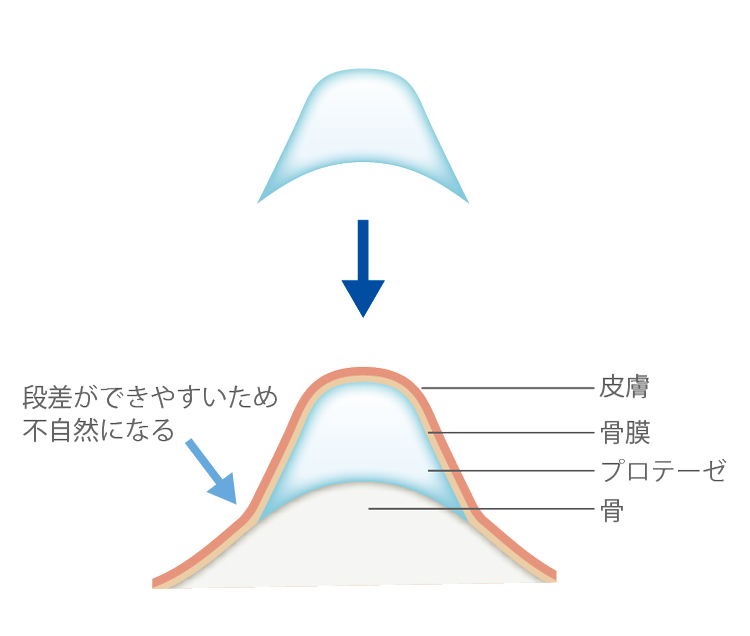 ※当院で使用していないプロテーゼ
