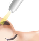 アートメイク除去(レーザー)