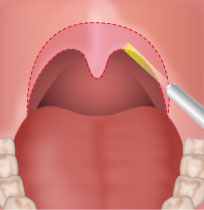いびき治療 切るレーザーによる口蓋垂・軟口蓋形成術(LAUP)