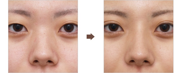 ヒアルロン酸注射で鼻筋を通したり 鼻を細くすることはできるのか Dr 高須幹弥の美容整形講座 美容整形の高須クリニック