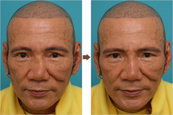 右から見た鼻の形と左から見た鼻の形が違うのが悩みの人はどうしたら良いのか Dr 高須幹弥の美容整形講座 美容整形の高須クリニック
