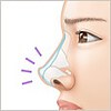 他院で受けた手術の修正(鼻)