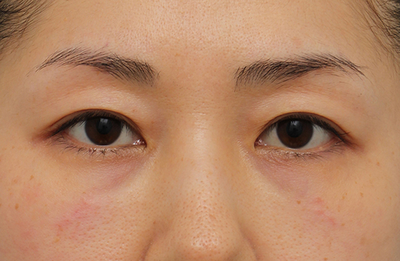 目の下のクマ治療の症例写真 美容整形の高須クリニック 東京赤坂 横浜 名古屋 大阪