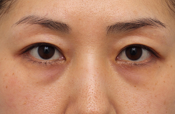 目の下のクマ治療の症例写真 美容整形の高須クリニック 東京赤坂 横浜 名古屋 大阪