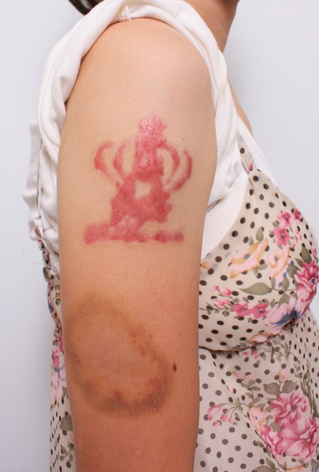 若い女性の肩の大きな入れ墨を剥削手術で除去した症例写真 ： 美容整形の高須クリニック（東京赤坂・横浜・名古屋・大阪）