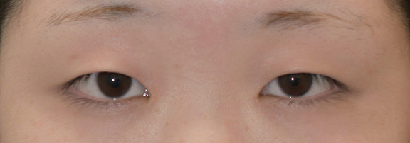 症例写真,二重まぶた・全切開法の症例 一重瞼から二重瞼になった女性,Before,ba_sekkai069_b01.jpg