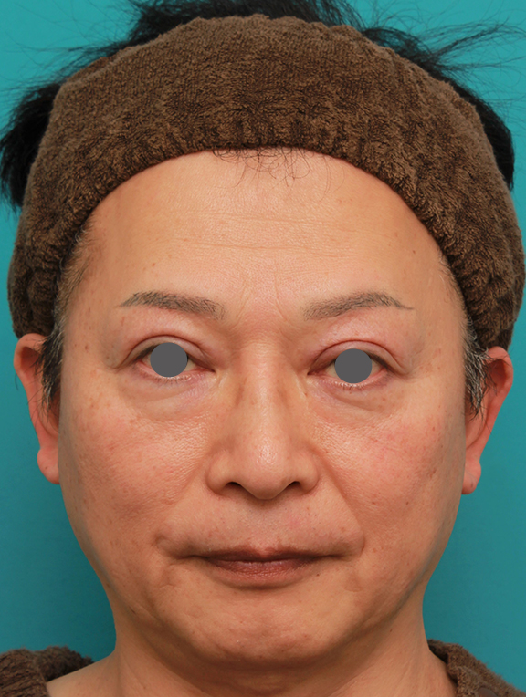 50代の男性の鼻にシリコンプロテーゼを入れて鼻筋を通した症例写真 美容整形の高須クリニック 東京赤坂 横浜 名古屋 大阪