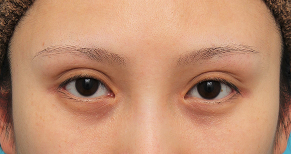 黒目を大きくする手術はあるのか 眼瞼下垂手術や目頭切開などで黒目は大きくなるのか Dr 高須幹弥の美容整形講座 美容整形の高須クリニック