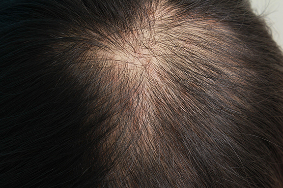 AGA治療（高須式メディカル育毛プログラム）,HARG治療（女性の薄毛治療）の症例写真,Before,ba_aga_josei002_b01.jpg