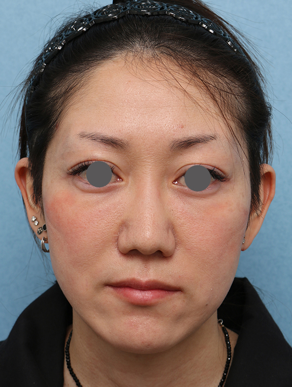 ウルセラシステム,ウルセラシステムの症例 フェイスラインが引き締まり小顔になった女性,After（2ヶ月後）,ba_ulthera034_b01.jpg