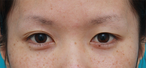 目の左右差を両目の埋没法で修正した症例写真 美容整形の高須クリニック 東京赤坂 横浜 名古屋 大阪
