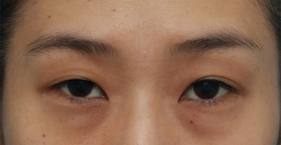 片目の埋没法を行い 左右対称の二重まぶたにした症例写真 美容整形の高須クリニック 東京赤坂 横浜 名古屋 大阪