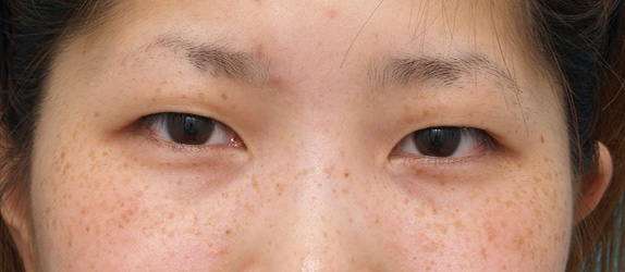 二重まぶた・ミニ切開法（部分切開）の症例 術後1ヶ月、目もとがくっきりした20代女性,Before,ba_minisekkai13_b.jpg