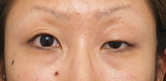 片目の先天性眼瞼下垂に対する手術の症例写真 美容整形の高須クリニック 東京赤坂 横浜 名古屋 大阪