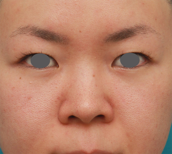 鼻翼縮小（小鼻縮小）,鼻のシリコンプロテーゼと小鼻（鼻翼）縮小手術をした20代女性の症例写真,Before,ba_ryubi74_b.jpg