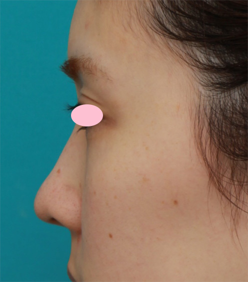 症例写真,耳介軟骨移植で鼻先を斜め下方向に出した症例写真,After（3ヶ月後）,ba_jikai38_b.jpg