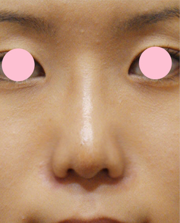 症例写真,鼻翼縮小（小鼻縮小）の症例写真 小鼻の張り出しを改善,After（1週間後）,ba_biyoku09_b.jpg