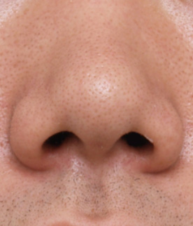 鼻翼縮小（小鼻縮小）,鼻翼縮小（小鼻縮小）の症例写真  鼻の穴が目立つ男性,Before,ba_biyoku15_b.jpg
