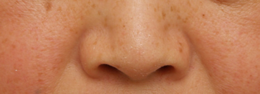 症例写真,鼻翼縮小（小鼻縮小）の症例写真  小鼻が大きく目立つ,Before,ba_biyoku14_b.jpg