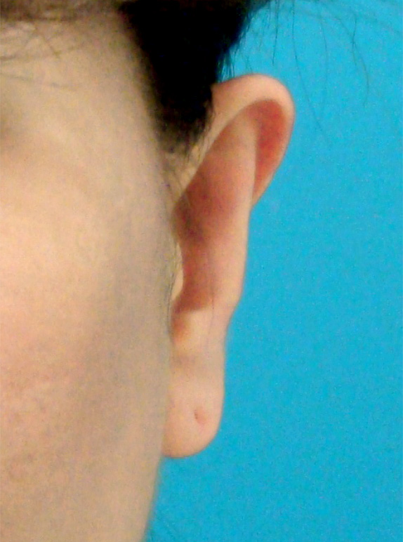 立ち耳,立ち耳の症例 いつも耳を隠すような髪型をしていた30代女性,After,ba_tachimimi02_b.jpg