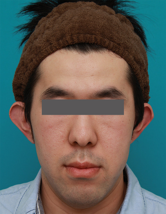 立ち耳,立ち耳を修正手術で治した症例写真,Before,ba_tachimimi03_b01.jpg