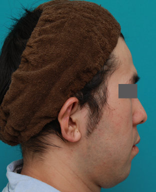 立ち耳,立ち耳を修正手術で治した症例写真,1週間後,mainpic_tachimimi03c.jpg