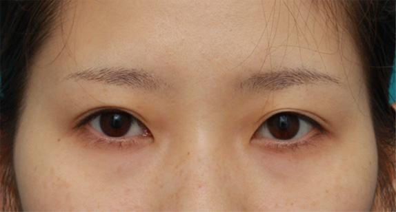 目から眉までの距離を近づけるにはどうしたらいいのか Dr 高須幹弥の美容整形講座 美容整形の高須クリニック
