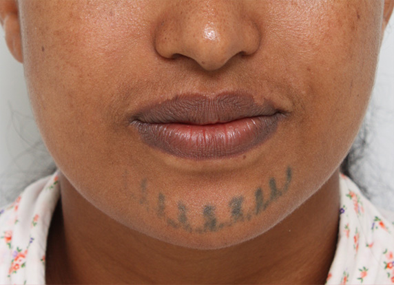 アフリカの黒人女性の顔面の入れ墨にレーザー治療した症例写真 美容整形の高須クリニック 東京赤坂 横浜 名古屋 大阪