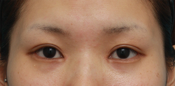 つり目を治すにはどの整形手術をすれば良いのか タレ目形成 目頭切開 目尻切開 二重まぶた手術 Dr 高須幹弥の美容整形講座 美容整形の高須クリニック