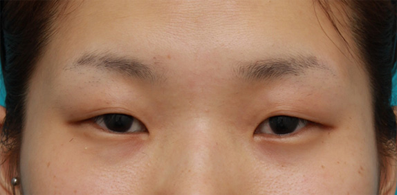 つり目を治すにはどの整形手術をすれば良いのか タレ目形成 目頭切開 目尻切開 二重まぶた手術 Dr 高須幹弥の美容整形講座 美容整形の高須クリニック