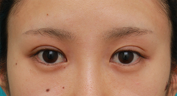 目頭切開,目尻切開,目頭切開+目尻切開で目の横幅を内側と外側に広げた20代女性の症例写真,Before,ba_megashira33_b.jpg