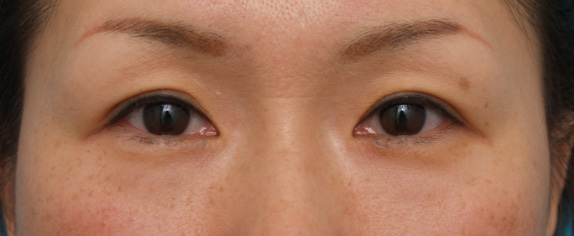 症例写真,目尻切開 30代女性、術後1ヶ月の症例写真,Before,ba_mejiri01_b.jpg