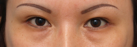 目尻切開の症例 大きな印象の目をご希望の20代女性,After（1週間後）,ba_mejiri02_a01.jpg