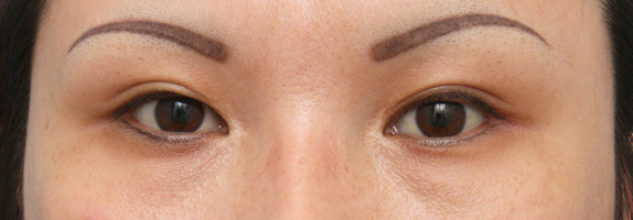 目尻切開の症例 大きな印象の目をご希望の20代女性,Before,ba_mejiri02_b.jpg