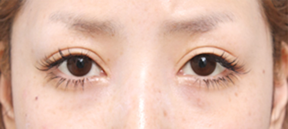 眼瞼下垂（がんけんかすい）の症例写真 目頭切開も施行,After,ba_ganken29_a01.jpg