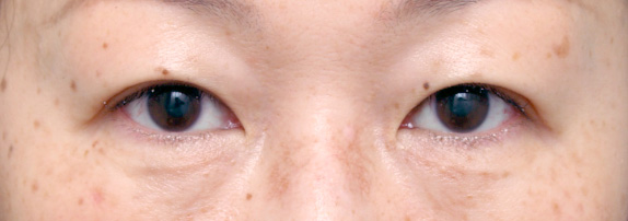 眼瞼下垂（がんけんかすい）,眼瞼下垂（がんけんかすい） 一重で目が小さく見えた30代女性の症例写真,After,ba_ganken19_a01.jpg