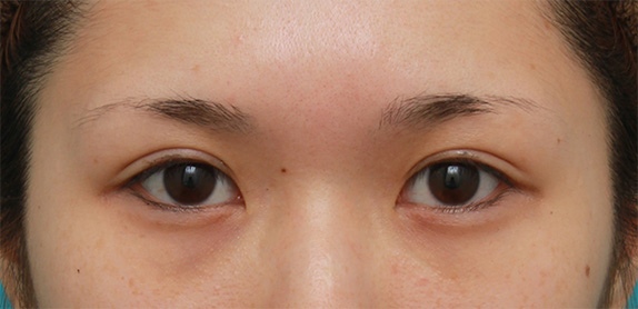 アイプチによるまぶたの皮膚の被れと二重まぶた手術について Dr 高須幹弥の美容整形講座 美容整形の高須クリニック