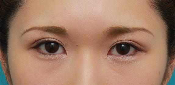アイプチによるまぶたの皮膚の被れと二重まぶた手術について Dr 高須幹弥の美容整形講座 美容整形の高須クリニック