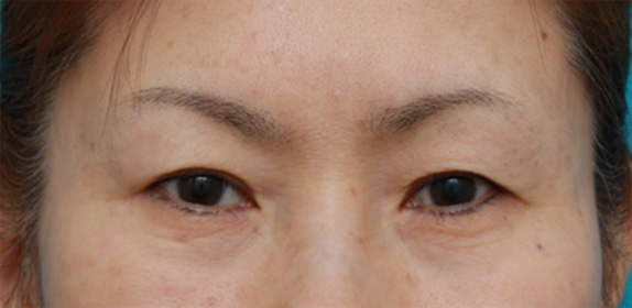 眉下リフト（上眼瞼リフト）,眉下リフト（上眼瞼リフト）の症例写真,Before,ba_tarumi25_b.jpg