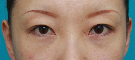 目の下の脂肪取り,目の下のクマに対して脂肪除去をした症例写真,After（メイクなし）,ba_tarumi19a_b.jpg
