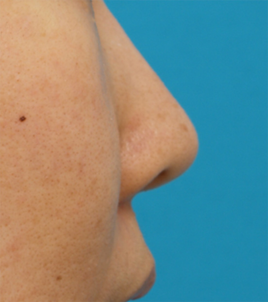 耳介軟骨移植（鼻先を出す）,耳介軟骨移植（鼻先を出す）の症例 鼻先が少し丸く厚みが気になる30代女性,Before,ba_jikai11_b.jpg
