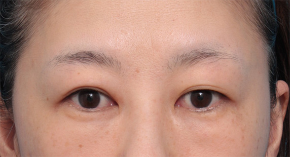 目の下の脂肪取り,目の下の脂肪を取り、埋もれていた涙袋が浮き出てきた症例写真の術前術後画像,Before,ba_shibo12_b.jpg
