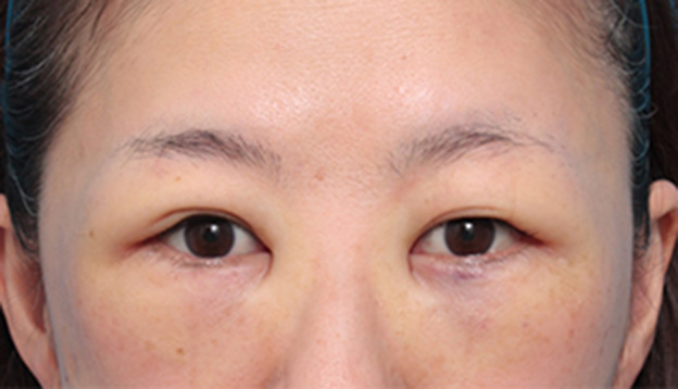 目の下の脂肪取り,目の下の脂肪を取り、埋もれていた涙袋が浮き出てきた症例写真の術前術後画像,手術直後,mainpic_shibo06b.jpg