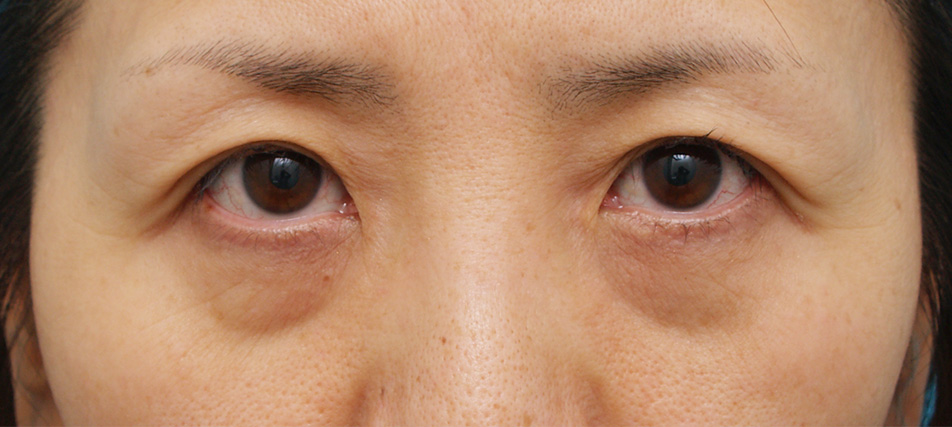 目の下のクマ治療 ヒアルロン酸注入 美容整形の高須クリニック 東京赤坂 横浜 名古屋 大阪